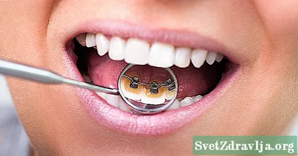 Niềng răng bên trong: Mặt trước và mặt dưới của niềng răng mặt sau - Chăm Sóc SứC KhỏE