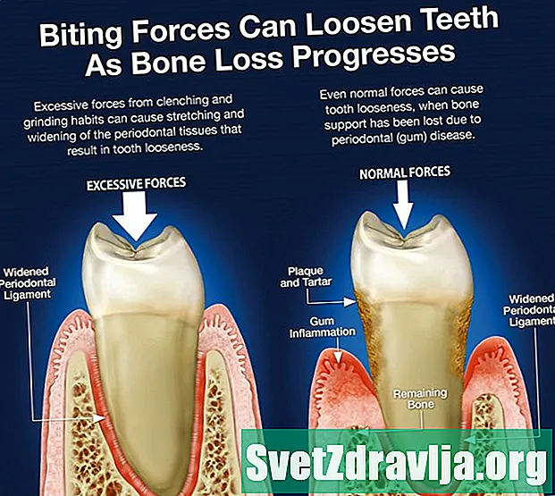 Lahtised hambad täiskasvanutel: mida peaksite teadma - Tervis