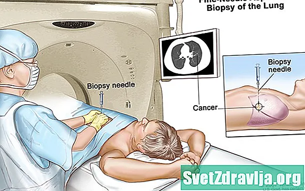 Biopsie plicní jehly: Co lze očekávat - Zdraví