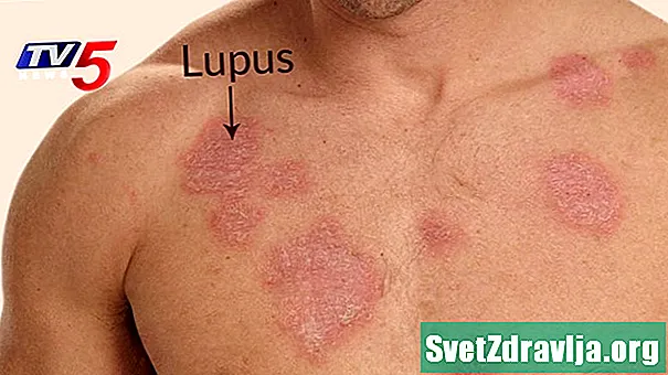 Lupus Outlook: Ako to ovplyvňuje môj život? - Zdravie