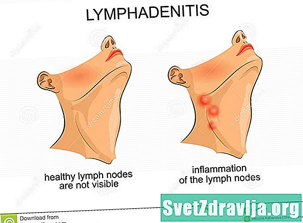 Athlasadh nód lymph (lymphadenitis)