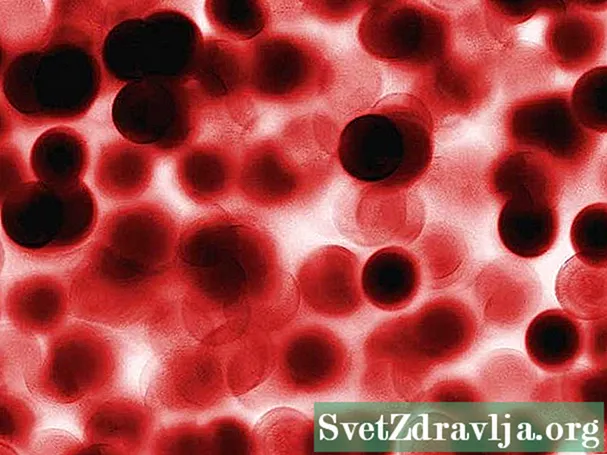 Anemia Makrocytic
