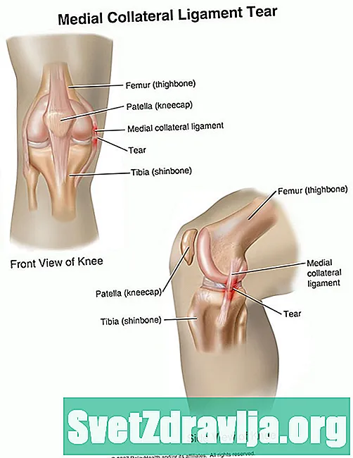 무릎의 내측 측부 인대 손상 (MCL 인열) - 건강