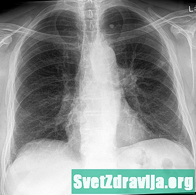 Metastatisk lungekræft: Forstå, hvad der kommer næste