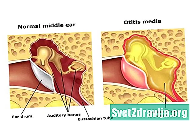 Infección del oído medio (otitis media) - Salud