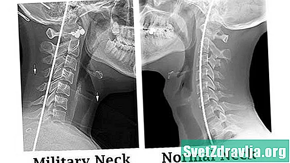 Katonai nyak (nyaki kyphosis) - Egészség