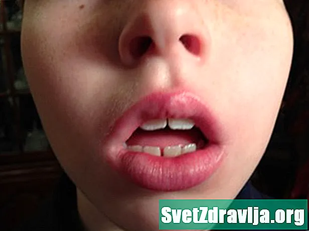 Suu hingamine: sümptomid, komplikatsioonid ja ravi - Tervis