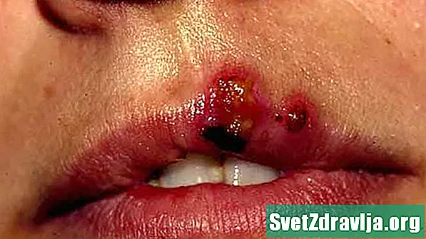 Bolečine v ustih: simptomi, zdravljenje in metode preprečevanja