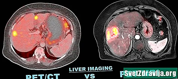 MRI vs PET Scan