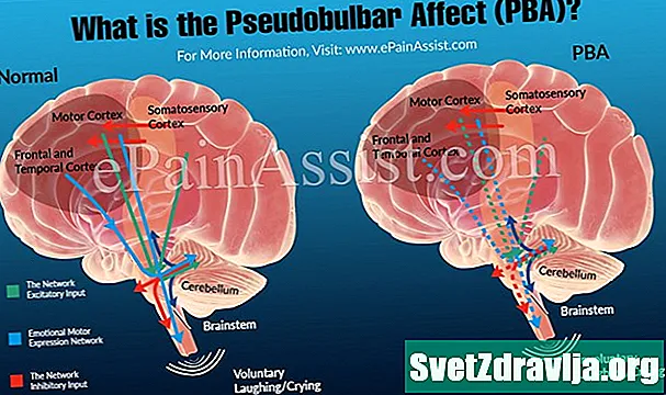 MS และ Pseudobulbar มีผลต่อ