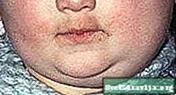 Mumps: Casg, Symptoms, agus Làimhseachadh