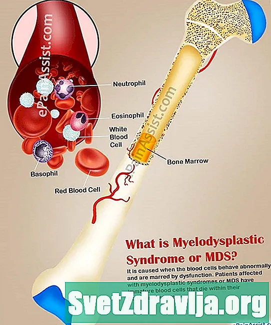 Миелодиспластични синдроми (MDS) - Здраве
