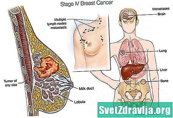 Krmarjenje po metastatskem raku dojk v menopavzi: iskanje podpore