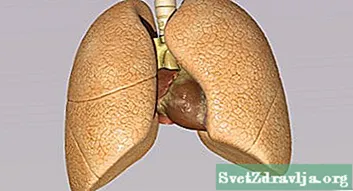 Isiri-Diki Sero Lung Cancer