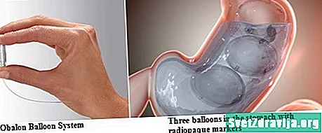 Sistema de balão Obalon para perda de peso não cirúrgico: o que você deve saber