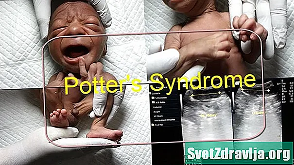 Seqüència d’oligohidramnios (síndrome de Potter) - Salut