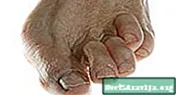 Артроз вялікага пальца ступні: сімптомы, прычыны і метады лячэння