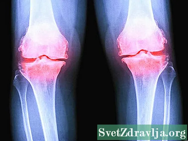 Artros i röntgen i knäet: vad man kan förvänta sig - Wellness
