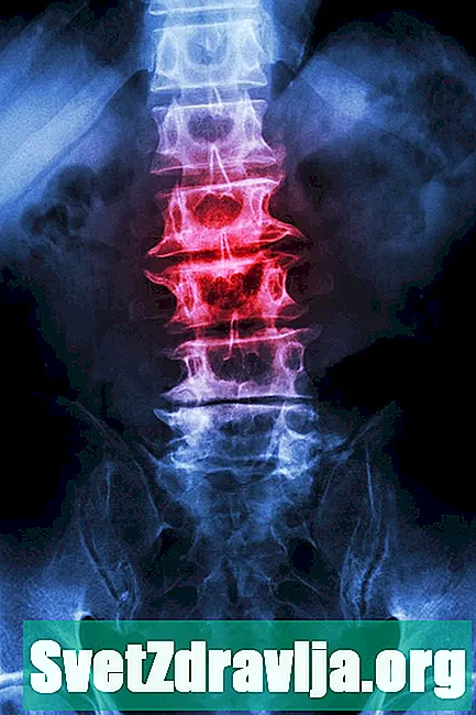 Artrosi della colonna vertebrale