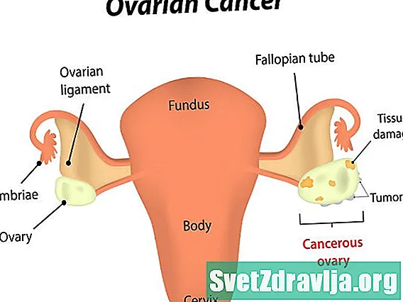 Câncer de ovário na gravidez
