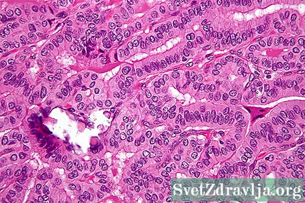 သိုင်းရွိုက်၏ Papillary carcinoma