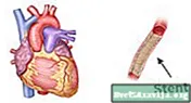Angioplastika e Arteries Periferike dhe Vendosja e Stentit