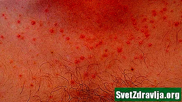 Zapalenie mieszków włosowych Pityrosporum - Zdrowie