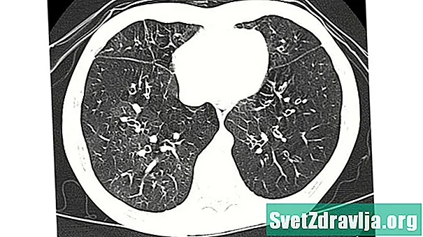 爆米花肺：如何预防和治疗这种呼吸系统疾病