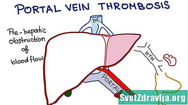 Portalo venų trombozė