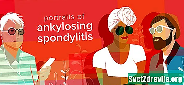 Portrete të Spondylitis Ankylosing - Shëndetësor