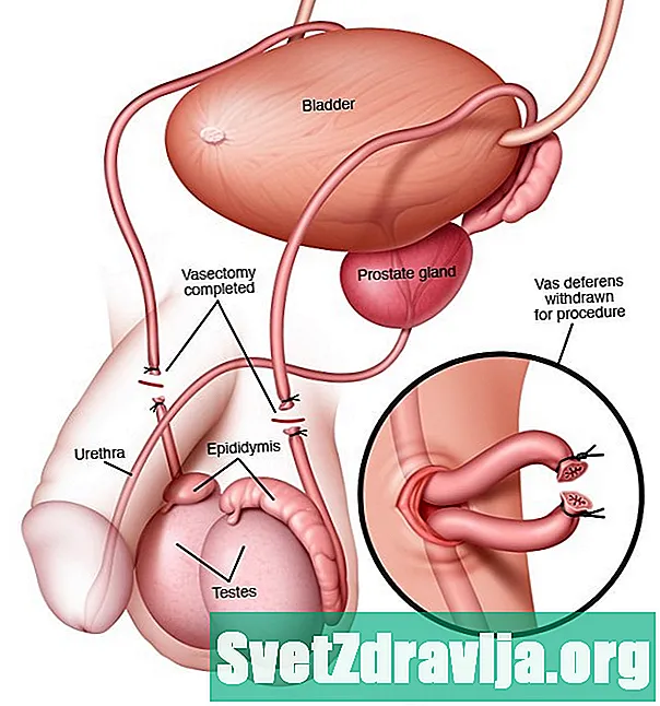 Mga Posibleng Komplikasyon Pagkatapos ng isang Vasectomy - Kalusugan