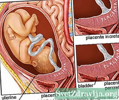 Fahasarotana amin'ny fitondrana vohoka: Placenta Accreta - Fahasalamana