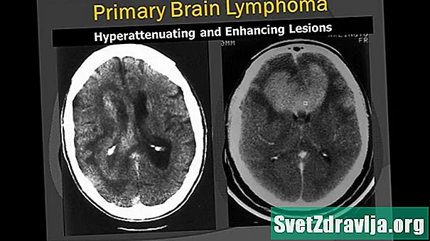 Lymphome cérébral primaire