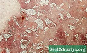 PSORIASIS Pictures