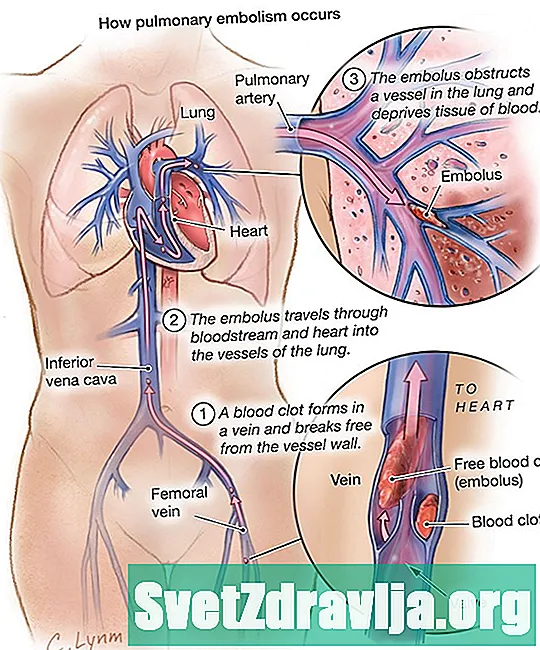 Plicní embolie - Zdraví