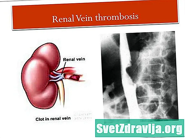 Trombóza ledvin (RVT) - Zdraví