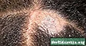 Miñoca do coiro cabeludo (Tinea Capitis) - Saúde