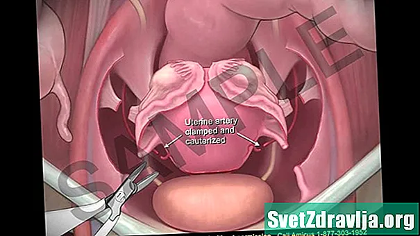 Salpingectomy: những gì mong đợi - SứC KhỏE