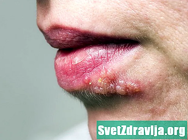 El herpes zóster en la cara: síntomas, tratamientos y más - Salud
