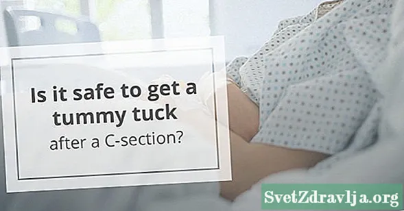 Si vos adepto Post tummy SUCCINGO C-section?