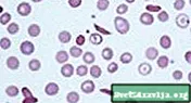 Српеста клеточна анемија
