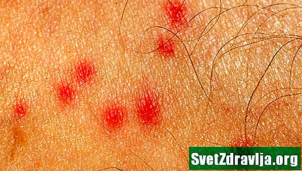 Skeeter Sindrom: Alergijske reakcije na ubode komaraca - Zdravlje