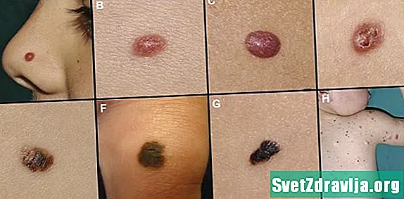 Рак шкіри у дітей (дитяча меланома)