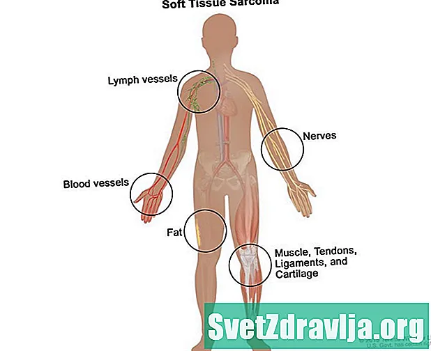 Yumşaq toxuma Sarcoma (Rhabdomyosarcoma) - Sağlamlıq