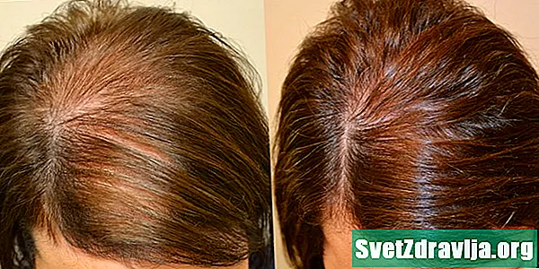 Spironolakton za gubitak kose: kako djeluje