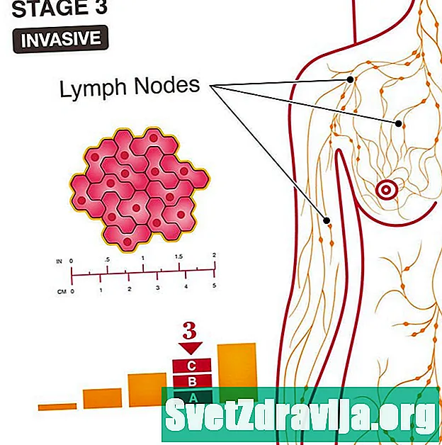 Етап 3 Рак на гърдата: Разбиране на вашите перспективи