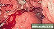 Mavekræft (gastrisk adenocarcinom)