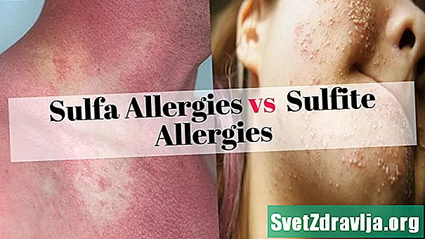 Alergije na Sulfa v primerjavi s Sulfitnimi alergijami - Zdravje