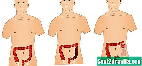 Cirugía para la enfermedad de Crohn
