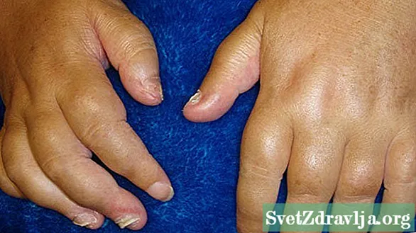 Mga Sintomas ng Psoriatic Arthritis
